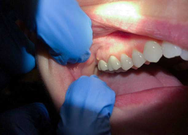 Best Emergency Care for Gum Disease in Owings, MD